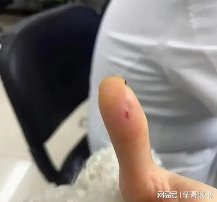 被餐厅筷子毛刺扎手花1.7万？从维权索赔到日常预防的深度避坑指南