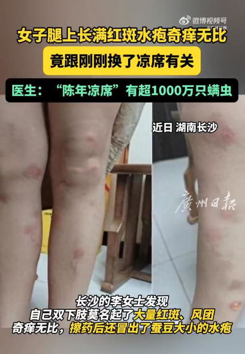 睡凉席腿上长满红斑？3种类型+7个急救方案，皮肤科医生亲授避坑指南